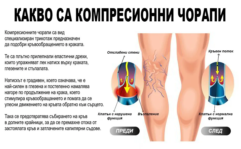Компресионни чорапи за разширени вени, отоци и умора 